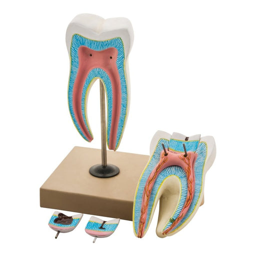 Human Upper Triple Root Molar with interchangeable cavities - 6 parts