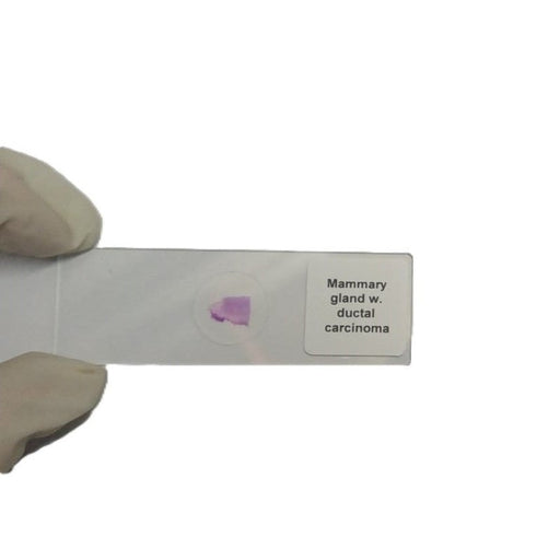 Microscope Slide - Mammary gland w. ductal carcinoma Individually packed in PP slide mailer