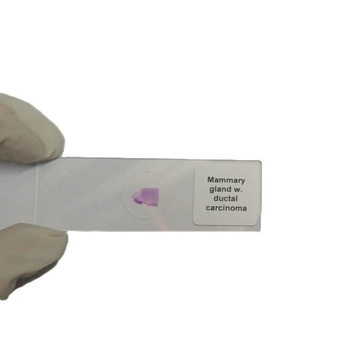 Microscope Slide - Mammary gland w. ductal carcinoma Individually packed in PP slide mailer