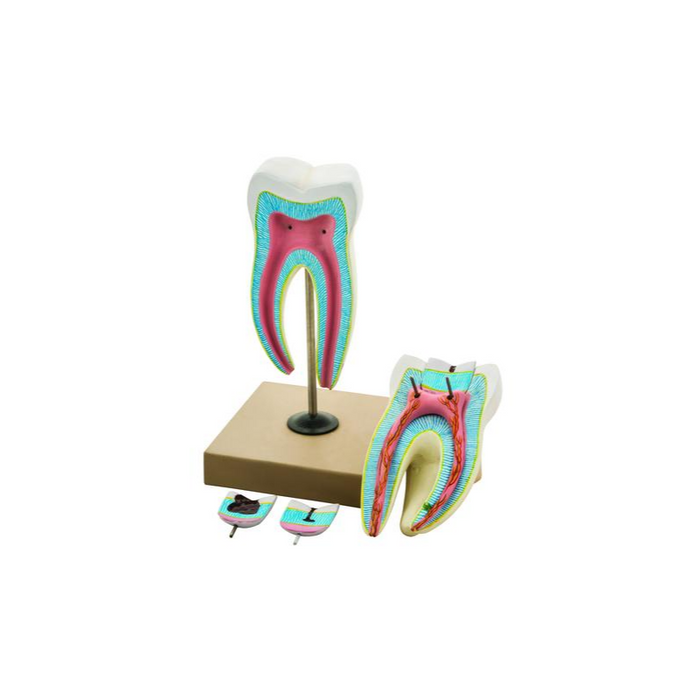 Model, Upper Triple Root with caries 15x6parts - SmartLabs