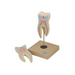 Model: Upper Root Molar with Caries - SmartLabs
